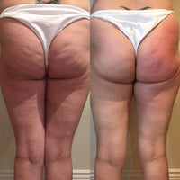 Ultrasonic Cavitation - AxenBox